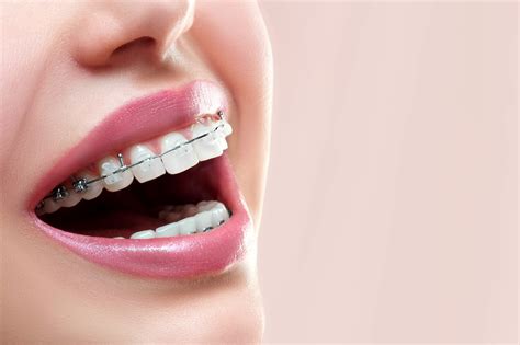 diferencia entre los brackets esteticos y metalicos|brackets invisibles precio.